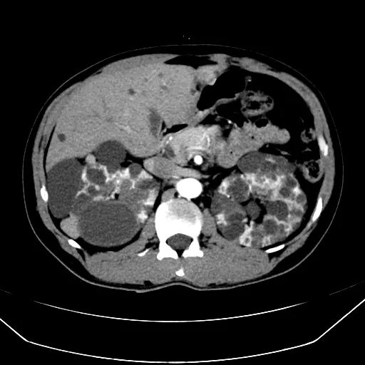 腹部肿瘤的CT检查技术2