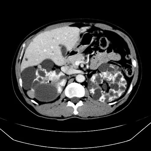 腹部肿瘤的CT检查技术3