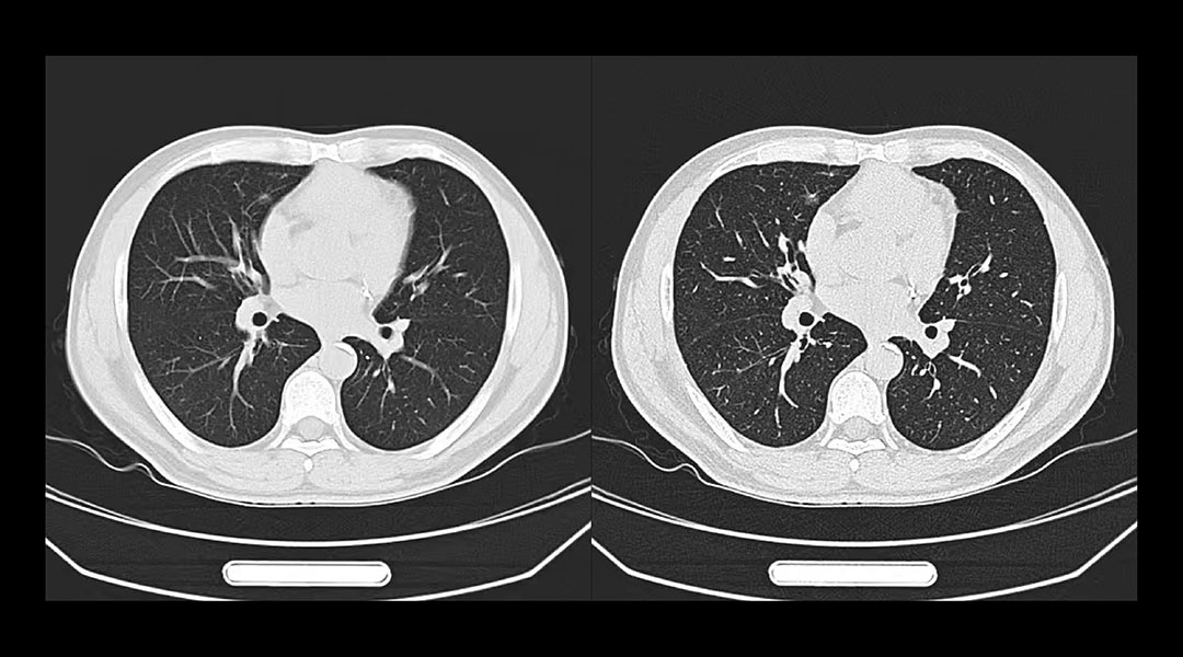 CT在肺部检查中的应用1