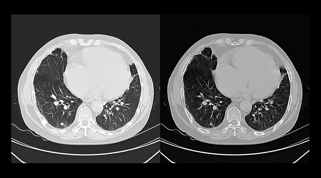 CT在肺部检查中的应用2