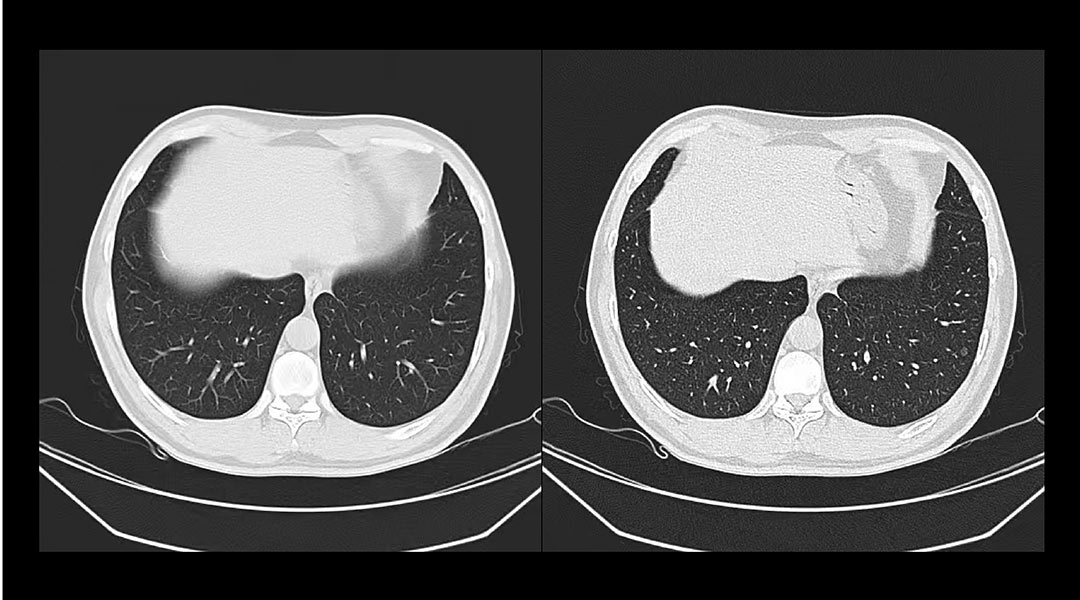 CT在肺部检查中的应用3
