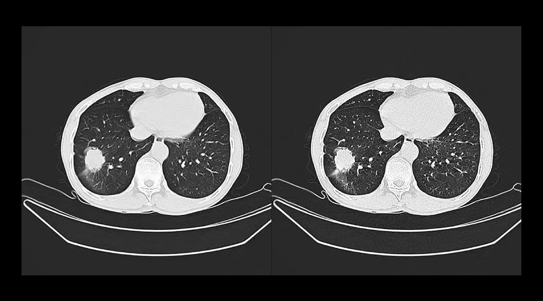 CT在肺部检查中的应用4