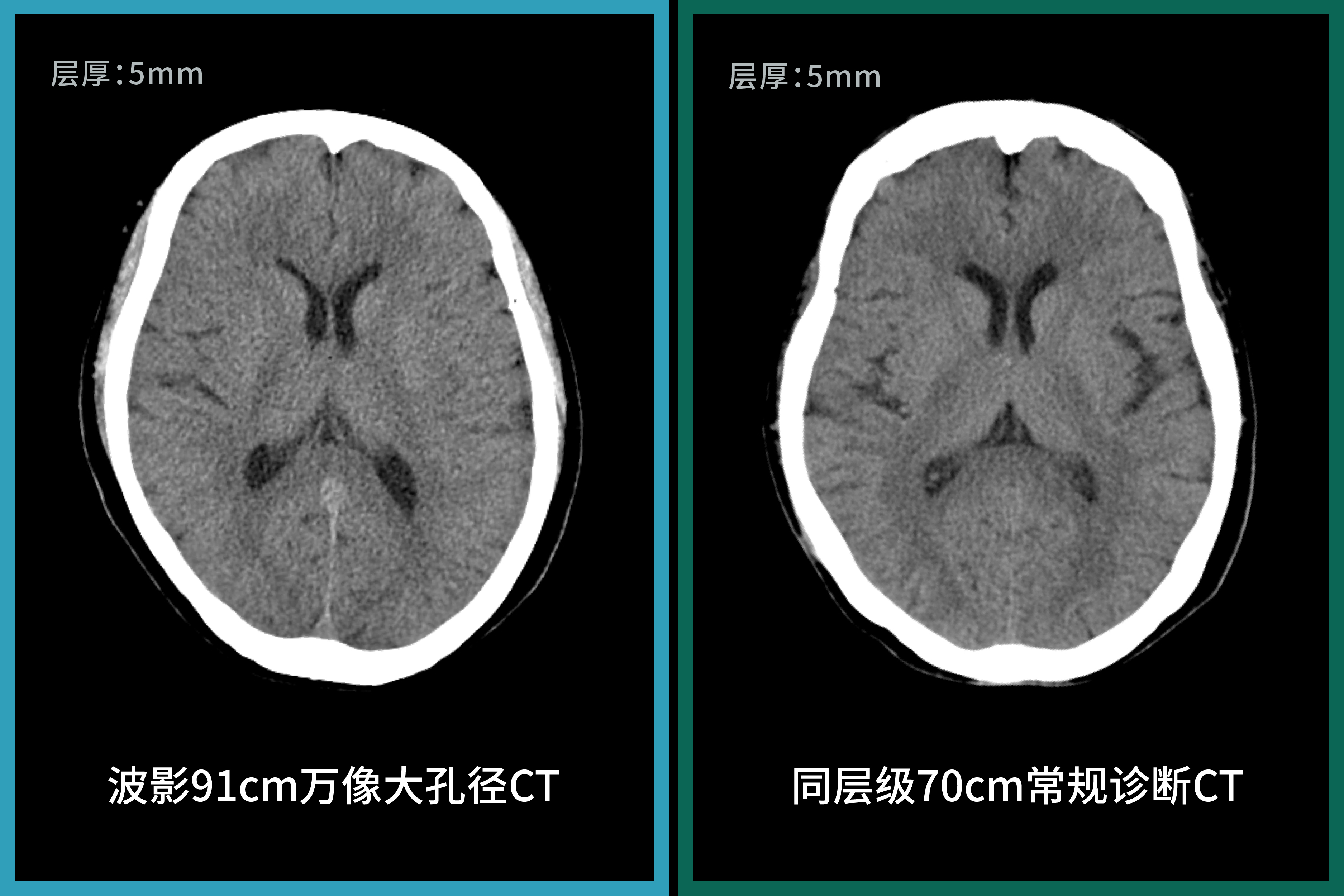 91cm孔径下的诊断级图像,波影万像大孔径CT与常规诊断CT图像对比-03.jpg 91cm孔径下的诊断级图像,波影万像大孔径CT与常规诊断CT图像对比-03.jpg