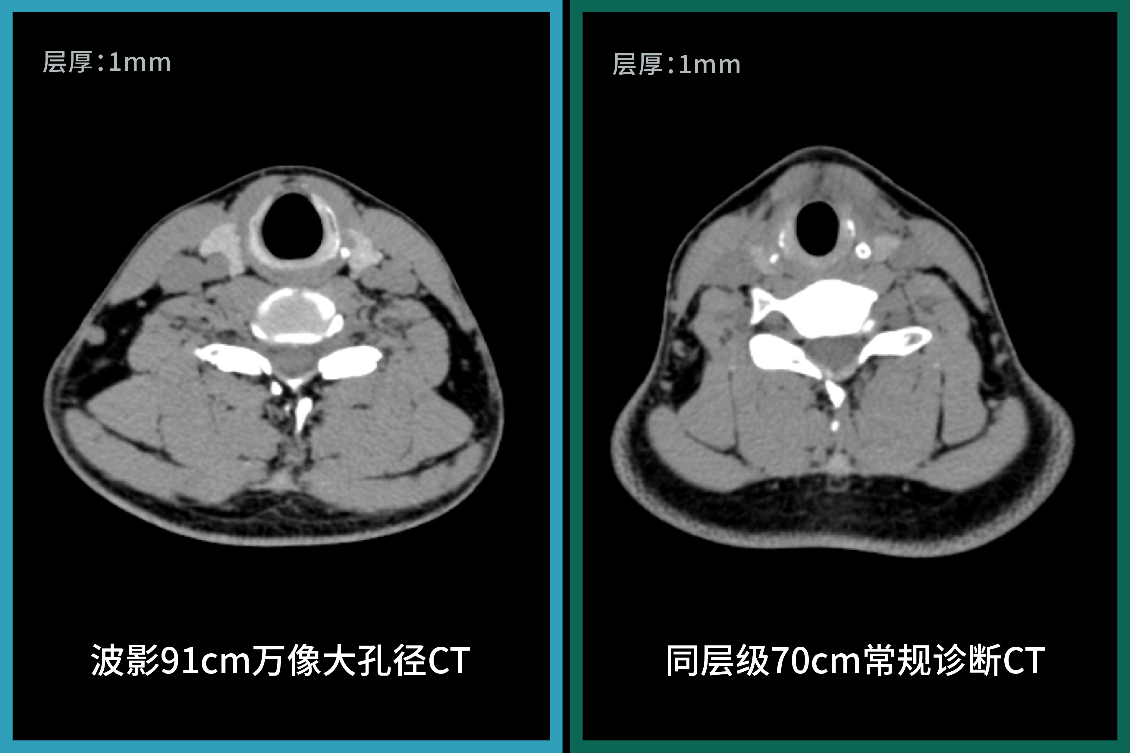91cm孔径下的诊断级图像,波影万像大孔径CT与常规诊断CT图像对比-04.jpg 91cm孔径下的诊断级图像,波影万像大孔径CT与常规诊断CT图像对比-04.jpg