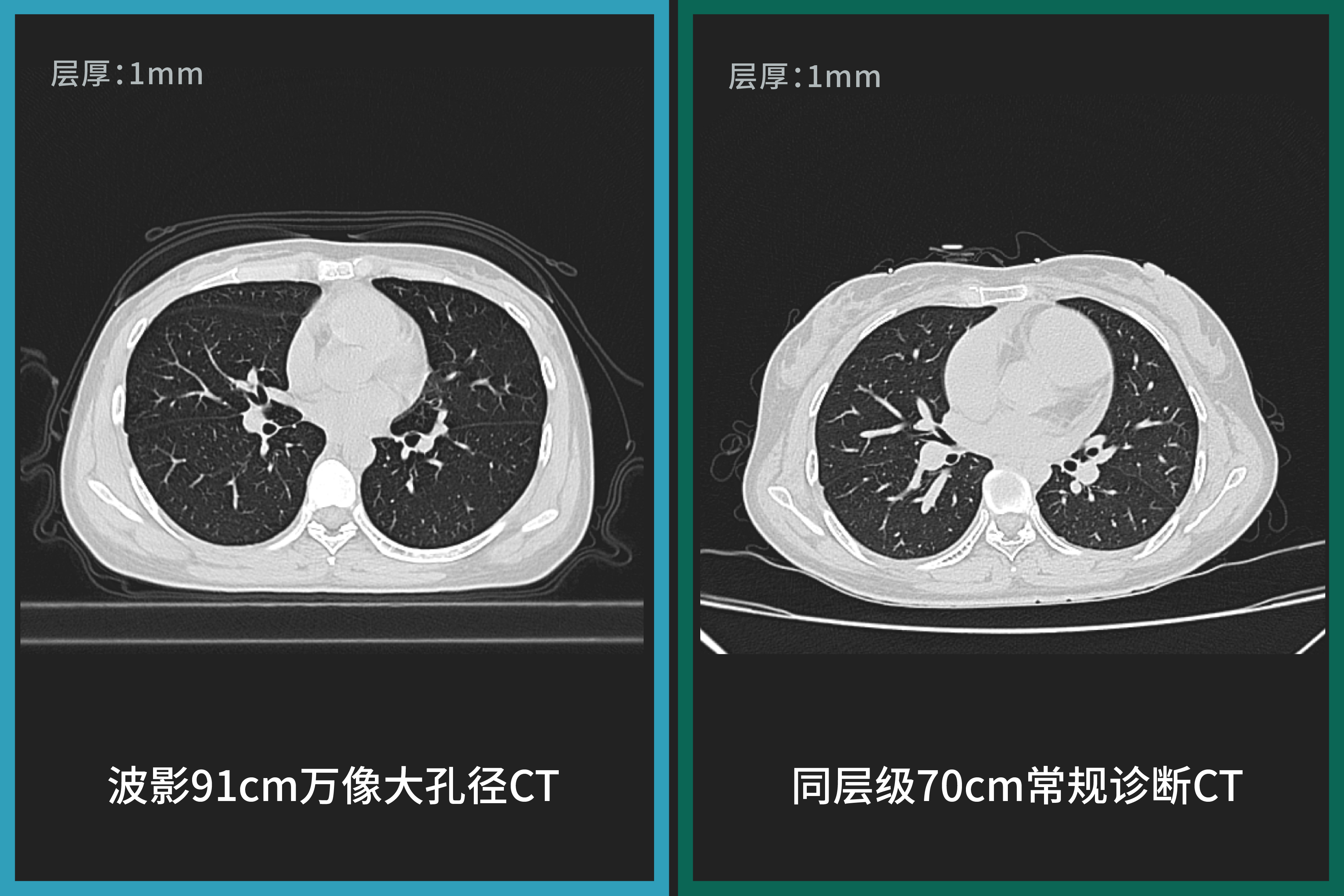 91cm孔径下的诊断级图像,波影万像大孔径CT与常规诊断CT图像对比-05.jpg 91cm孔径下的诊断级图像,波影万像大孔径CT与常规诊断CT图像对比-05.jpg