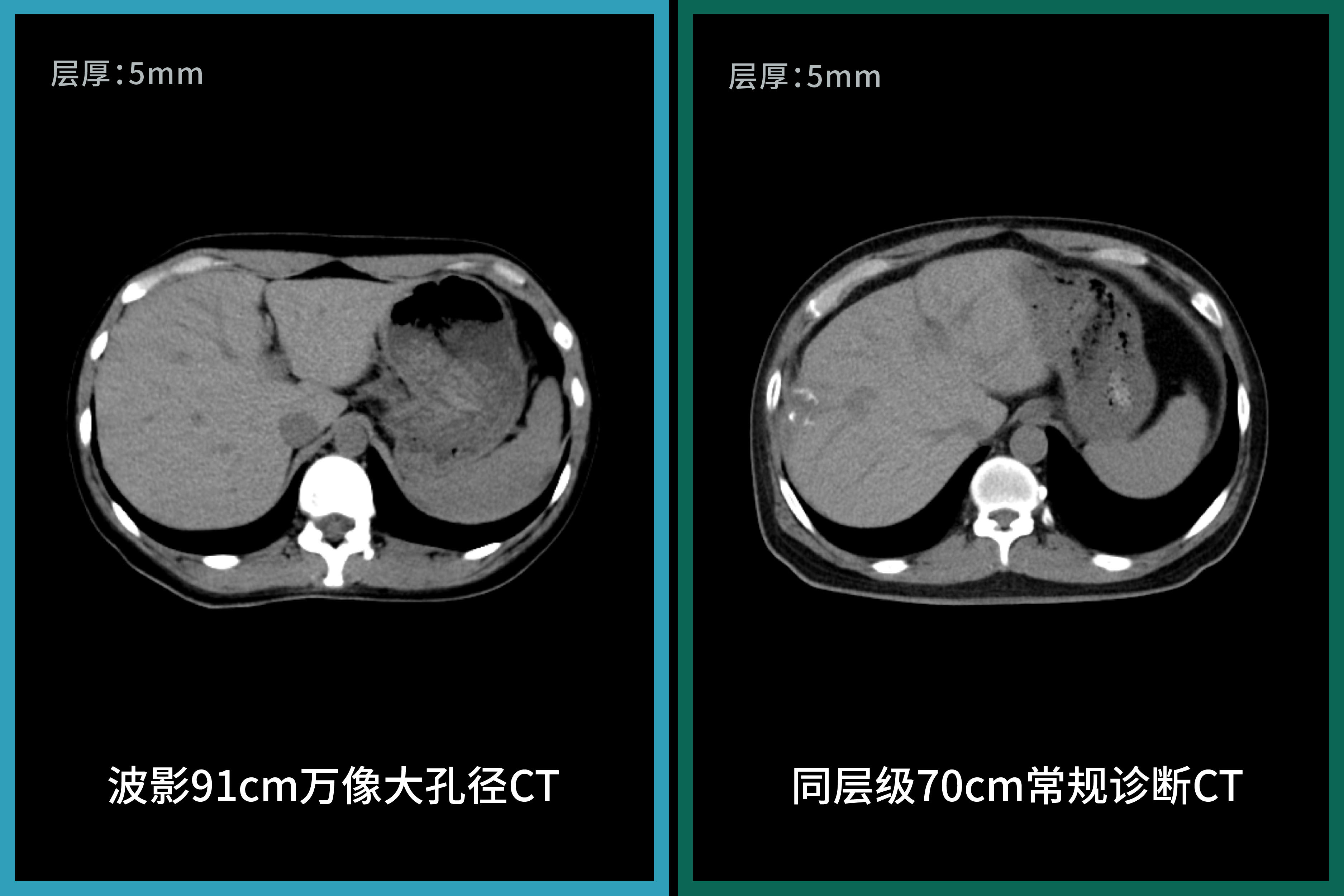 91cm孔径下的诊断级图像,波影万像大孔径CT与常规诊断CT图像对比-06.jpg 91cm孔径下的诊断级图像,波影万像大孔径CT与常规诊断CT图像对比-06.jpg