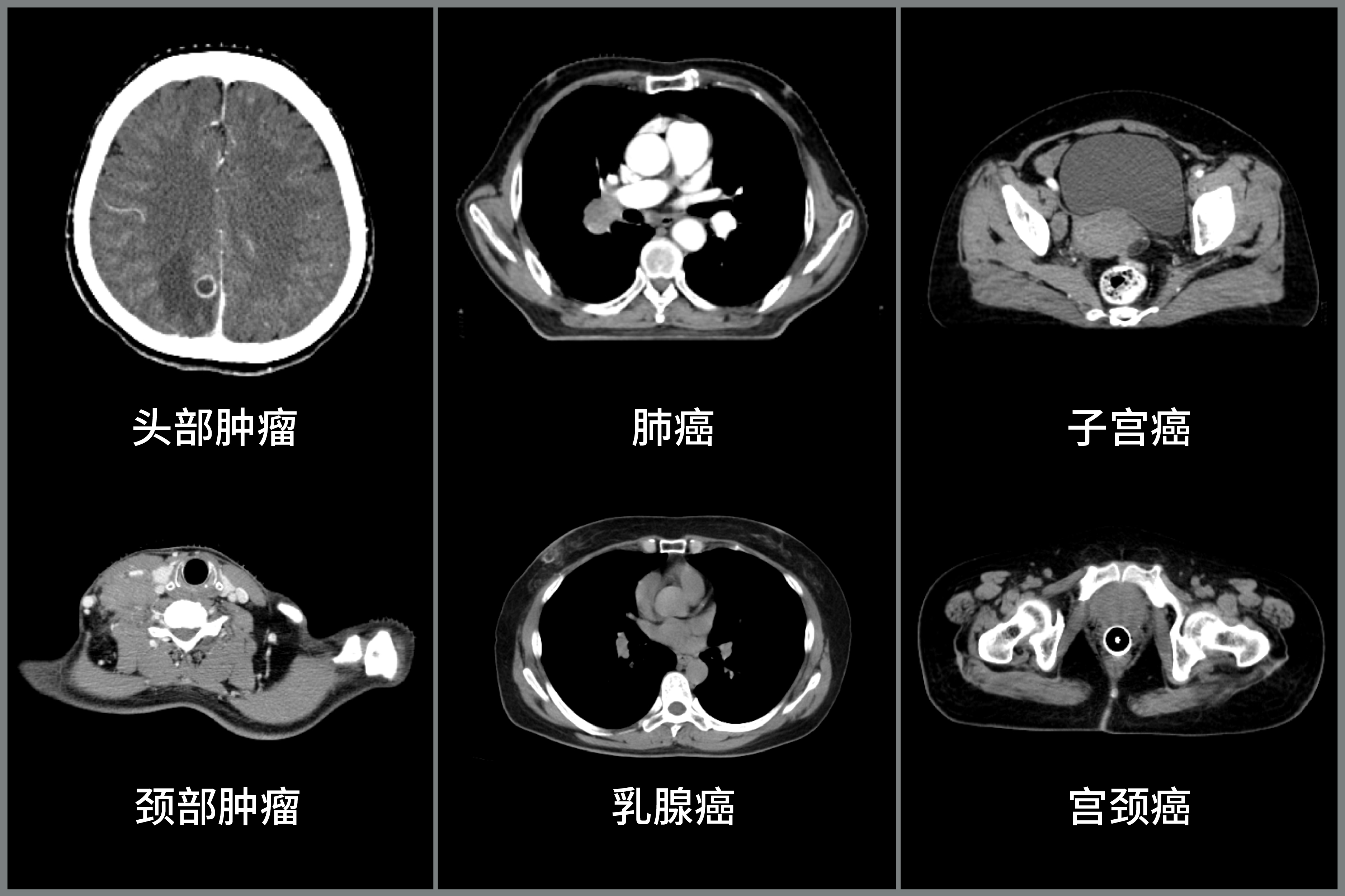 91cm孔径下的诊断级图像,波影万像大孔径CT与常规诊断CT图像对比-08.jpg 91cm孔径下的诊断级图像,波影万像大孔径CT与常规诊断CT图像对比-08.jpg