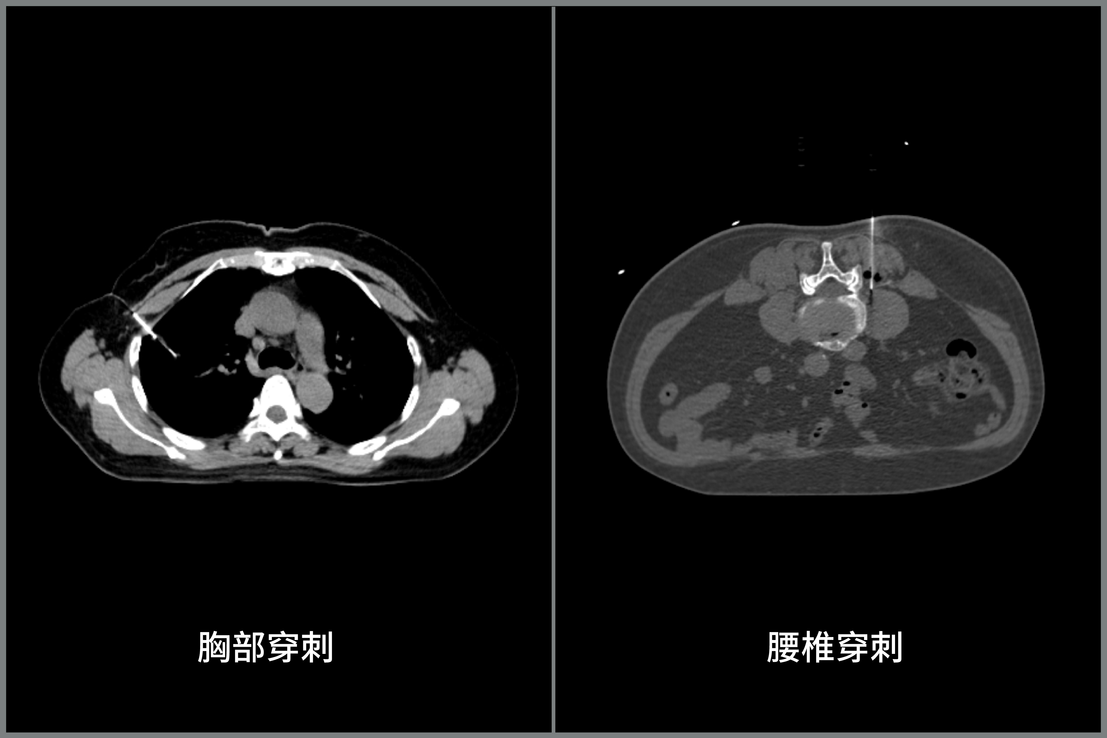 91cm孔径下的诊断级图像,波影万像大孔径CT与常规诊断CT图像对比-09.jpg 91cm孔径下的诊断级图像,波影万像大孔径CT与常规诊断CT图像对比-09.jpg